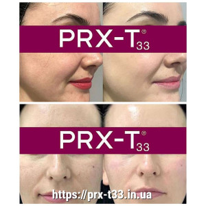 Пілінг PRX-T33: Скільки процедур потрібно для ідеального результату Пілінг PRX-T33: Скільки процедур потрібно для ідеального результату