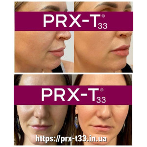 Пілінг PRX-T33 протипоказання Пілінг PRX-T33 протипоказання