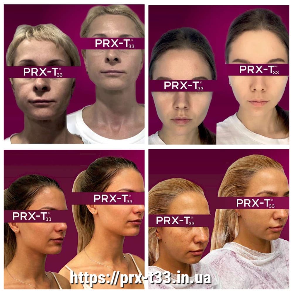 Пилинг PRX-T33  до и после 3